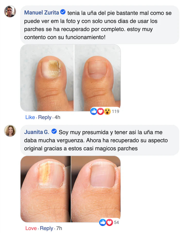 Parches mata hongos I OFERTA 3x1🎁Adiós a las uñas encarnadas!! NailsPatches